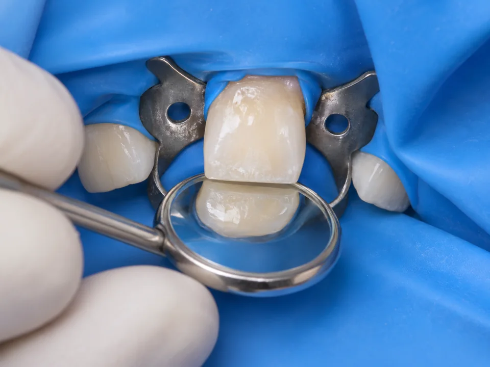 Illustrative external view of a permanent incisor isolated with a rubber dam during dental care