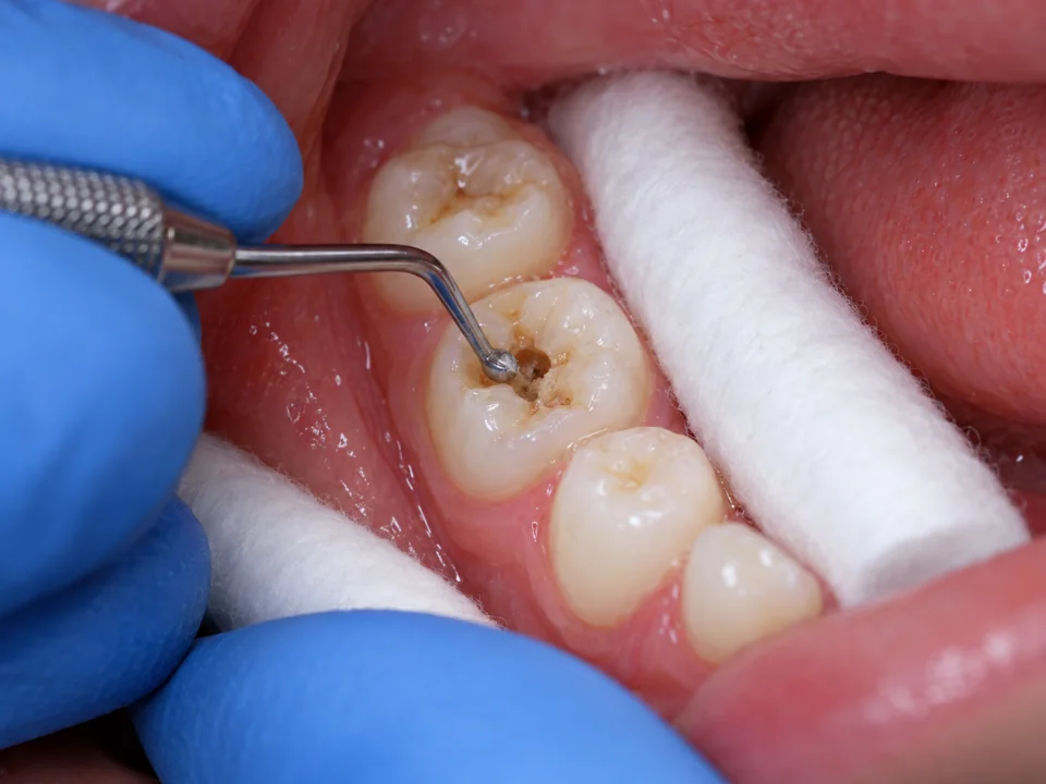 Illustrative close-up of a hand excavator managing a suitable cavity in a primary molar