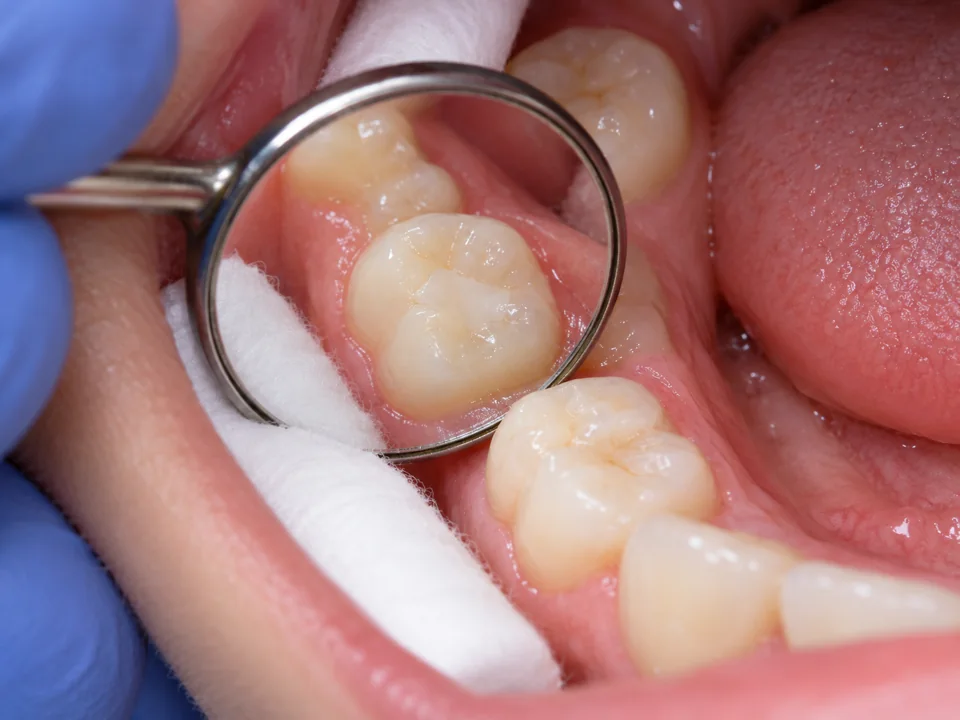 Illustrative close-up of a dental mirror checking a tooth-coloured glass-ionomer restoration in a primary molar
