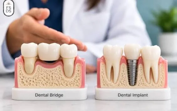 Practical dental teaching models comparing a tooth-supported bridge with a single dental implant and crown.
