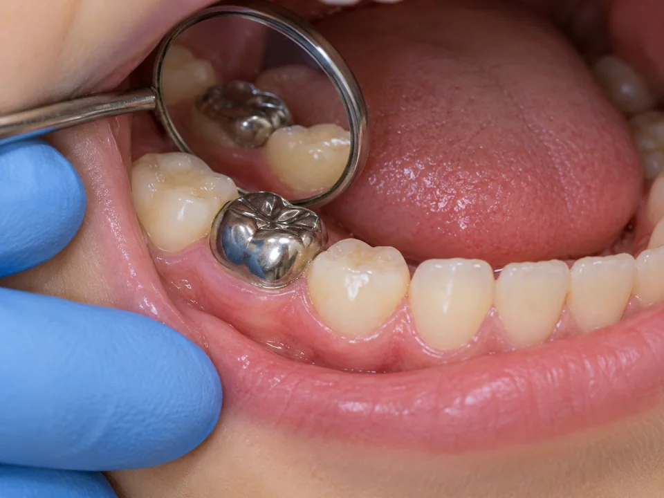 Illustrative close-up of a dental mirror checking a stainless steel crown on a primary molar