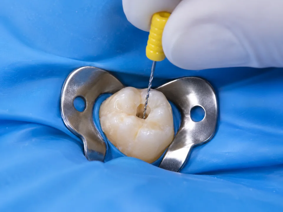Illustrative external view of a small endodontic hand file entering a primary molar under rubber-dam isolation