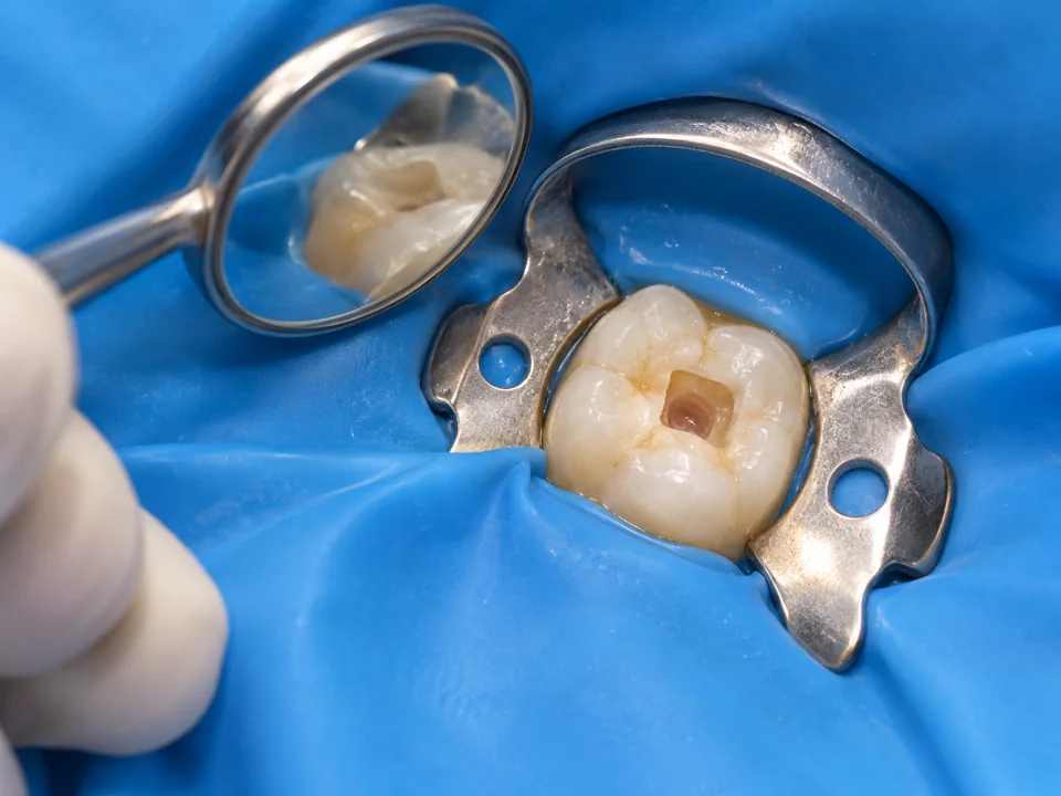 Illustrative external view of an access opening in a primary molar isolated with a rubber dam