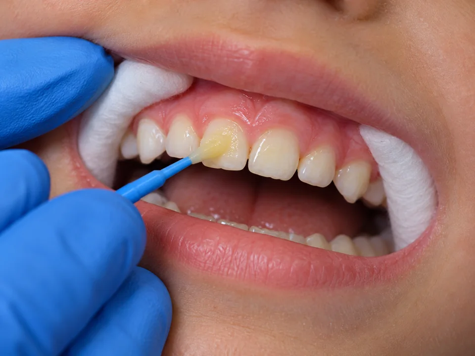 Illustrative close-up of a small brush applying fluoride varnish to a child’s teeth