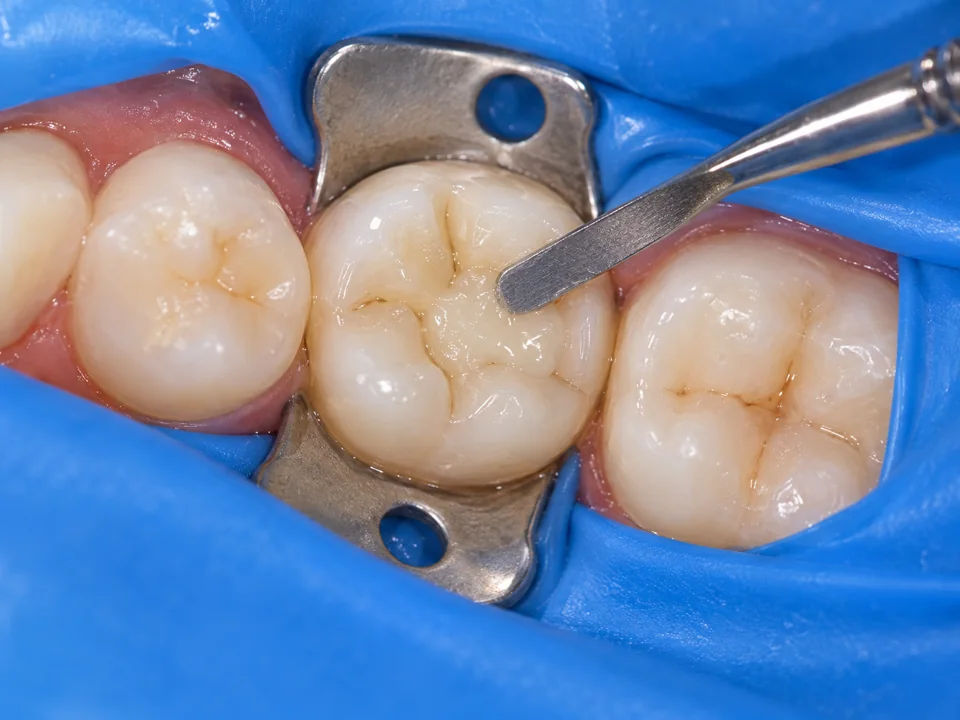 Illustrative close-up of tooth-coloured material being shaped in a primary molar under rubber-dam isolation