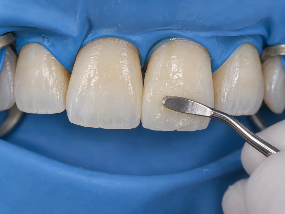 Illustrative composite veneer contouring on an upper central incisor under rubber dam isolation