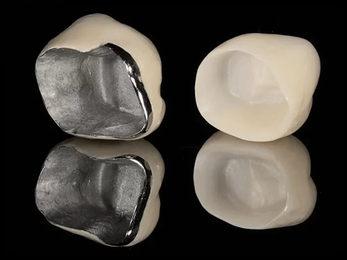 Dental crowns viewed from below, showing metal-lined and tooth-coloured hollow fitting surfaces