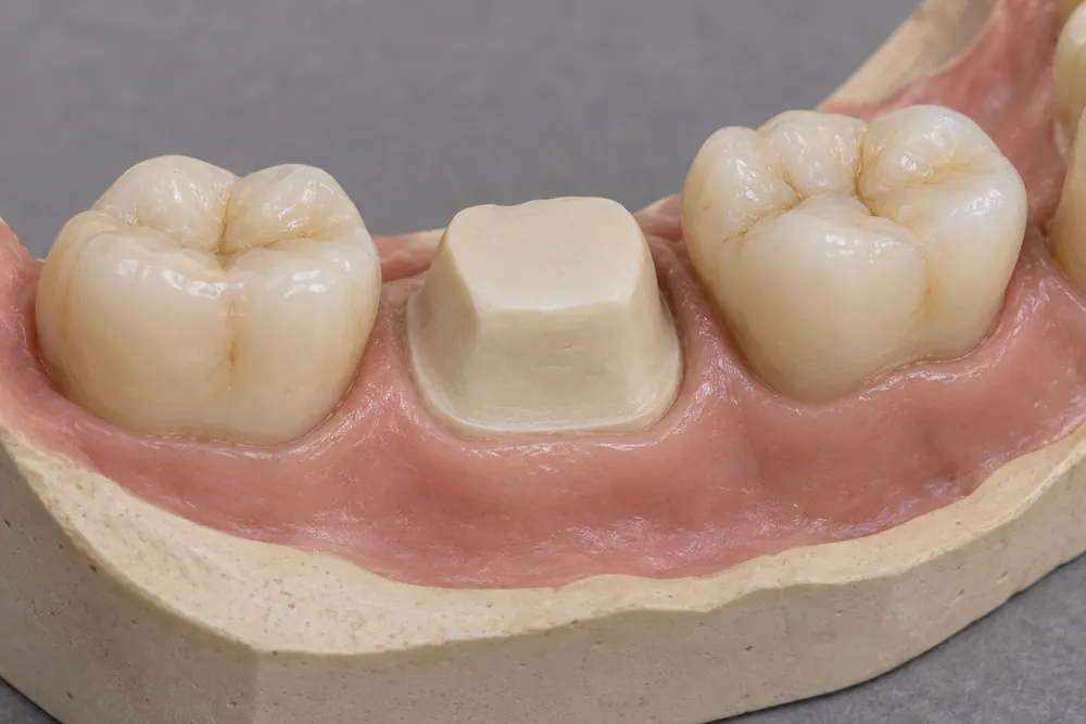 Illustrative prepared molar beside adjacent teeth before a crown is fitted