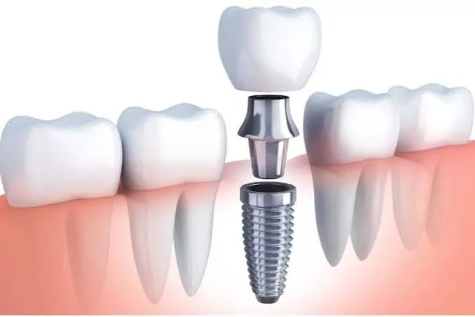 Exploded dental implant illustration showing the separate crown, abutment and threaded implant fixture between neighbouring teeth.
