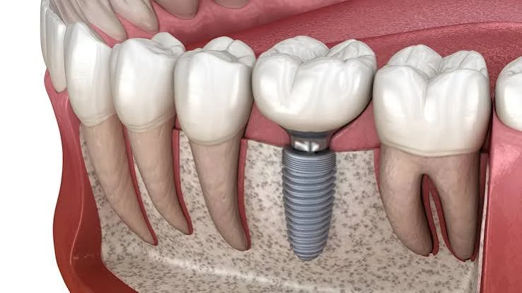 Dental Implants treatment guide