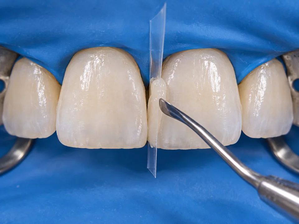Illustrative closure of a small gap between upper central incisors using tooth-coloured composite and a clear matrix strip