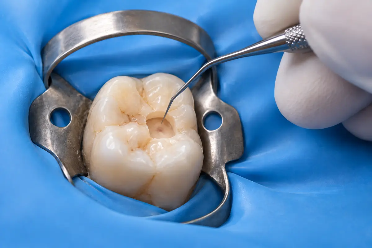 Direct Pulp Capping treatment guide