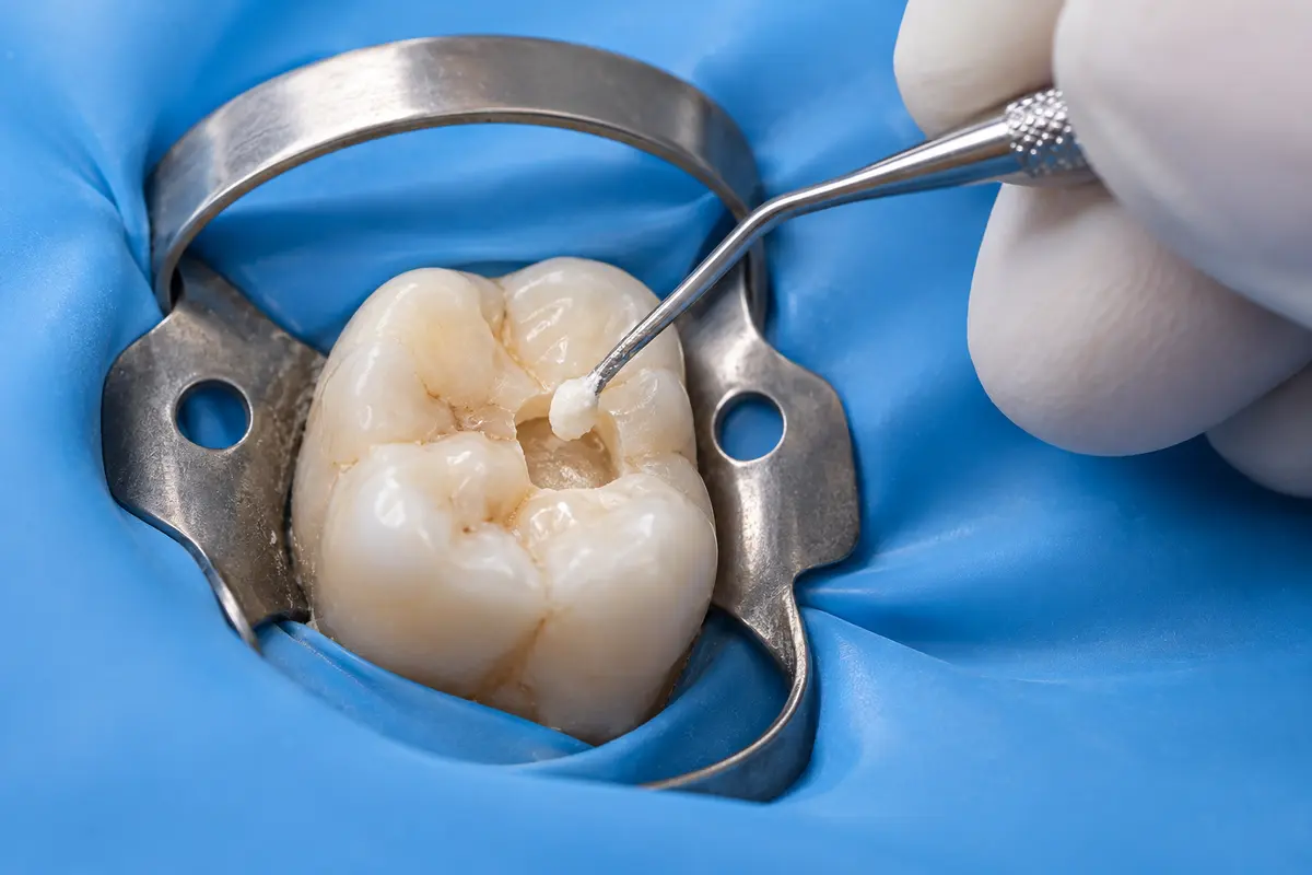 Clinical illustration of protect the exposure during direct pulp capping under a rubber dam