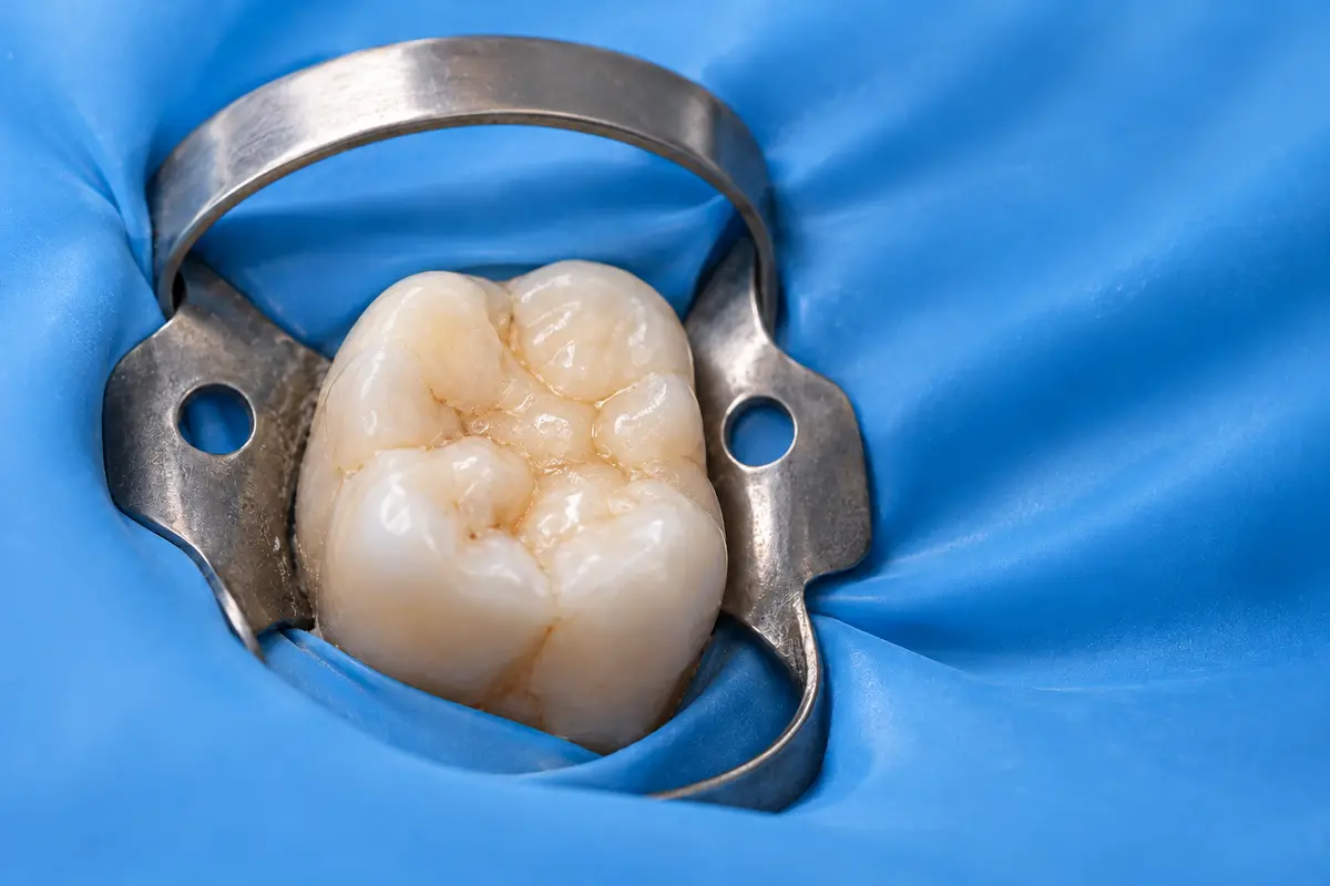Clinical illustration of restore and review during direct pulp capping under a rubber dam