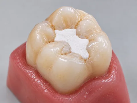 Temporary filling with a bright chalk-white, fine-grained matte appearance