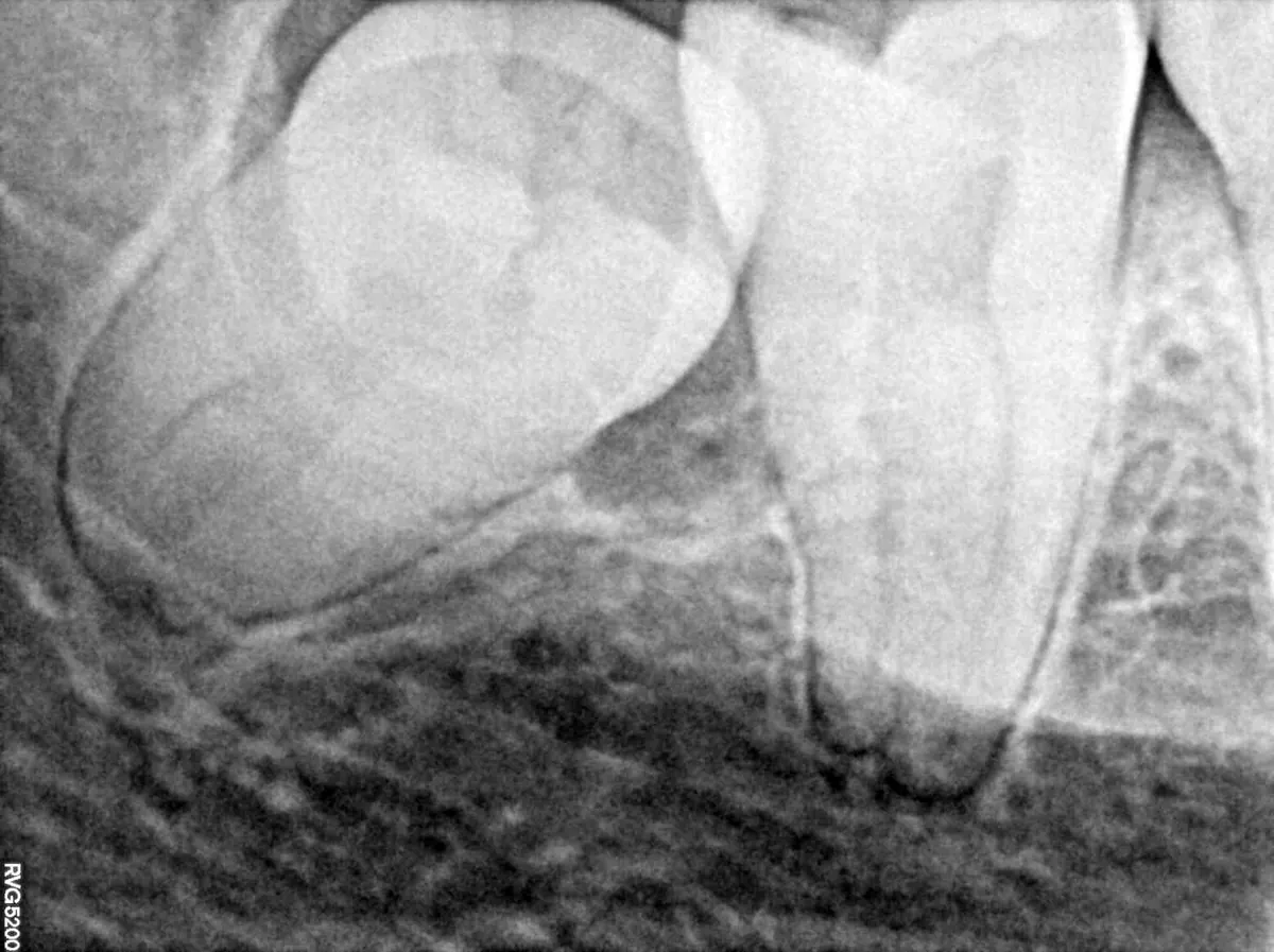 Dental radiograph showing a lower wisdom tooth tilted toward the neighbouring second molar.