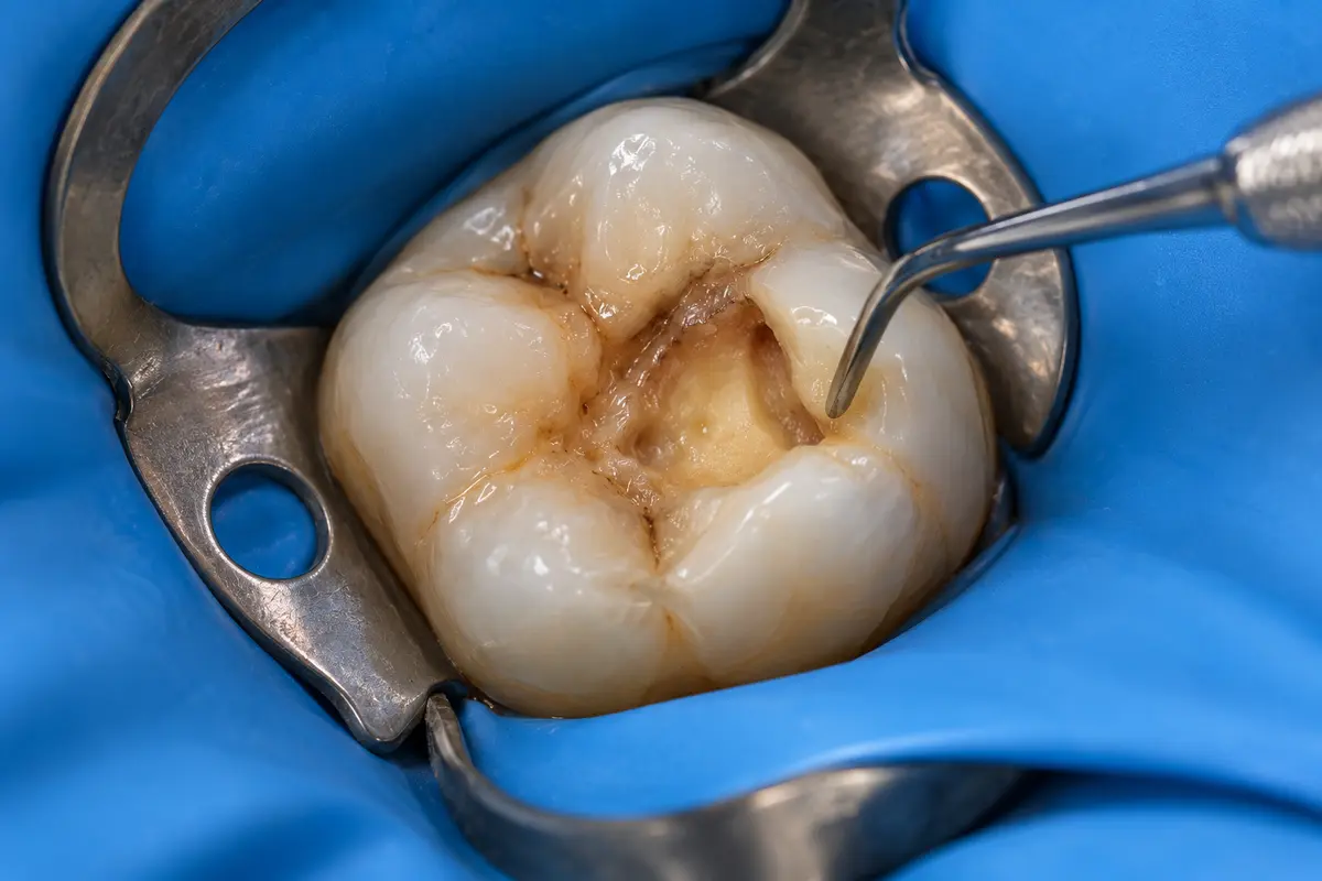 Indirect Pulp Capping treatment guide