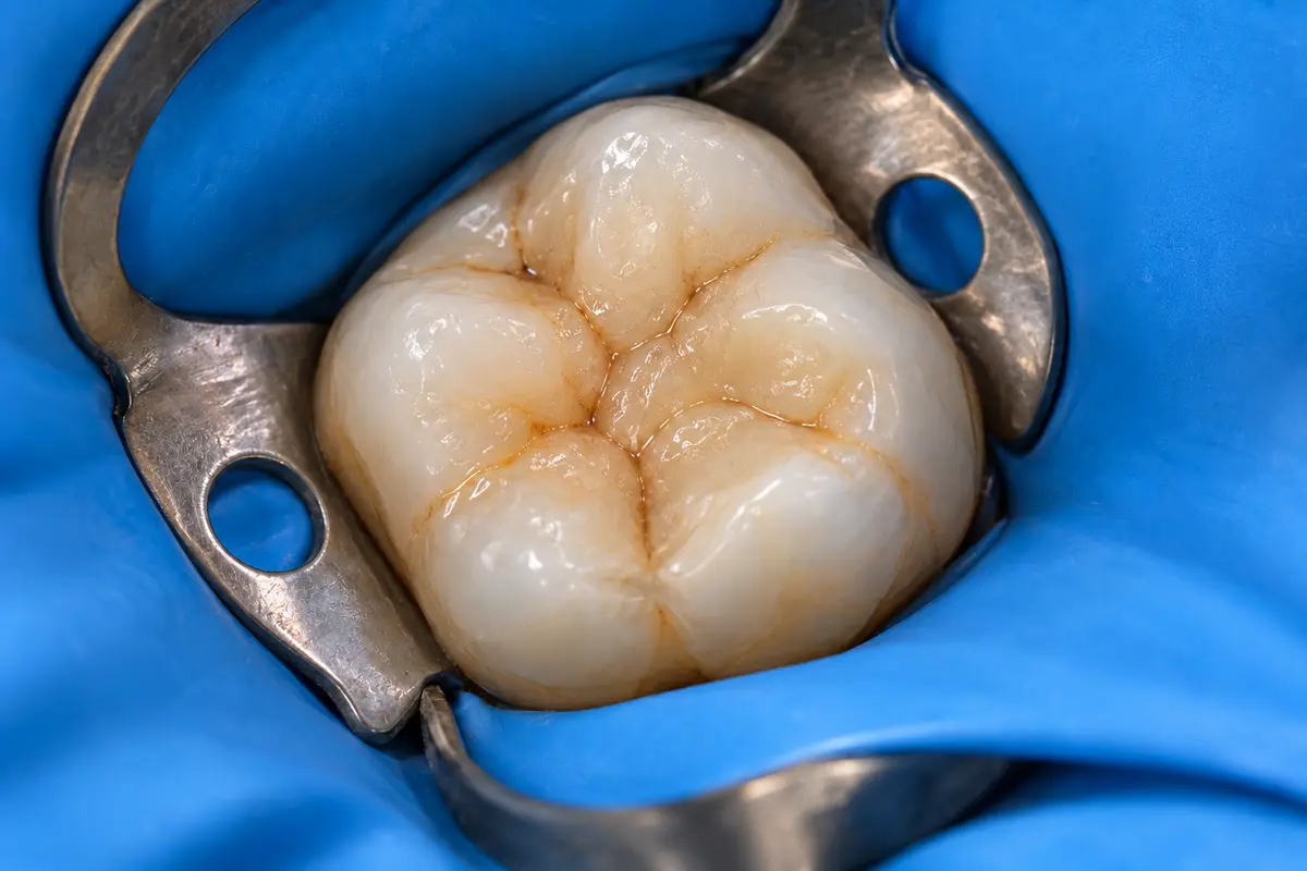 Clinical illustration: seal the tooth and review during indirect pulp capping