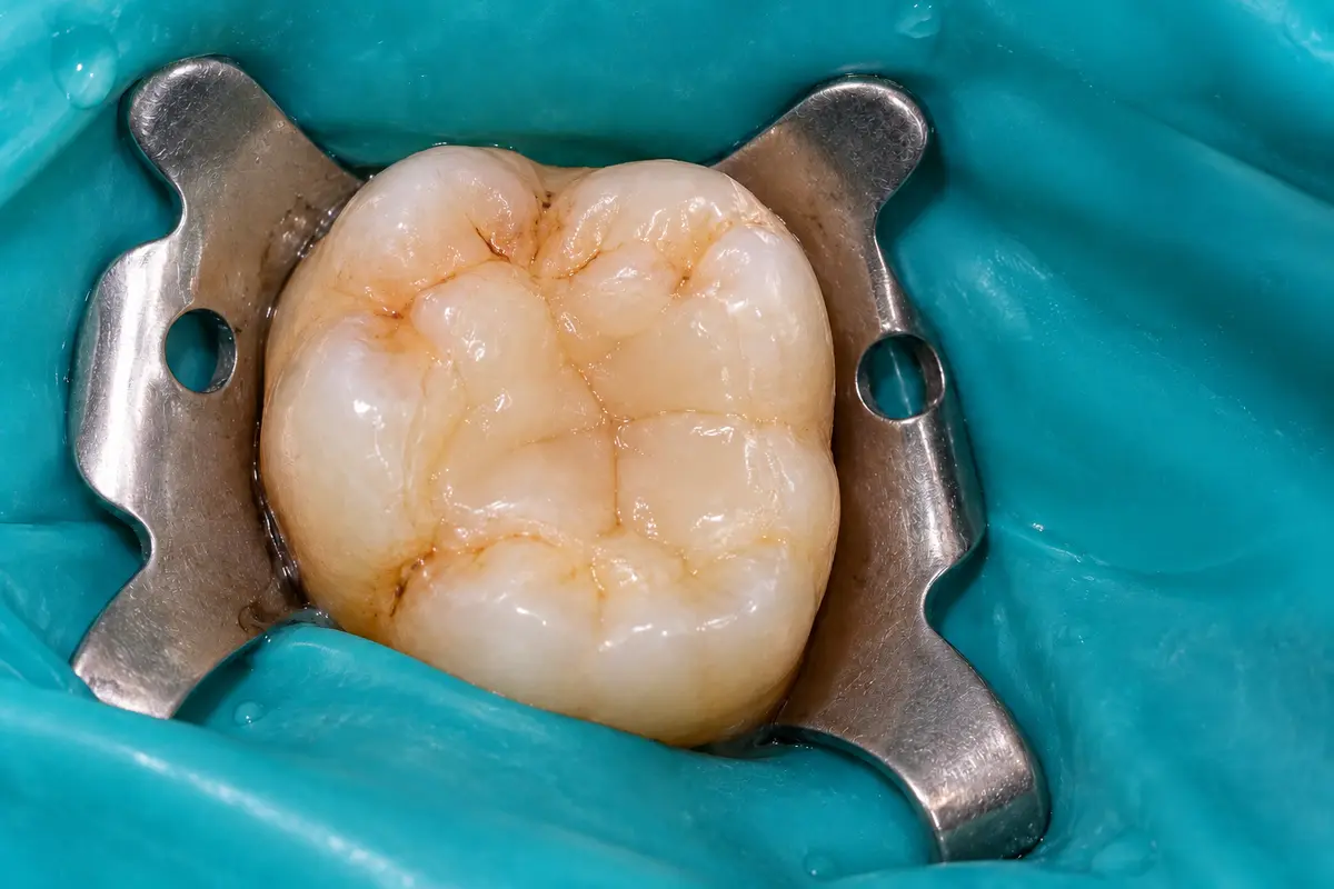 Clinical illustration: seal the tooth and monitor healing during pulpotomy for permanent teeth