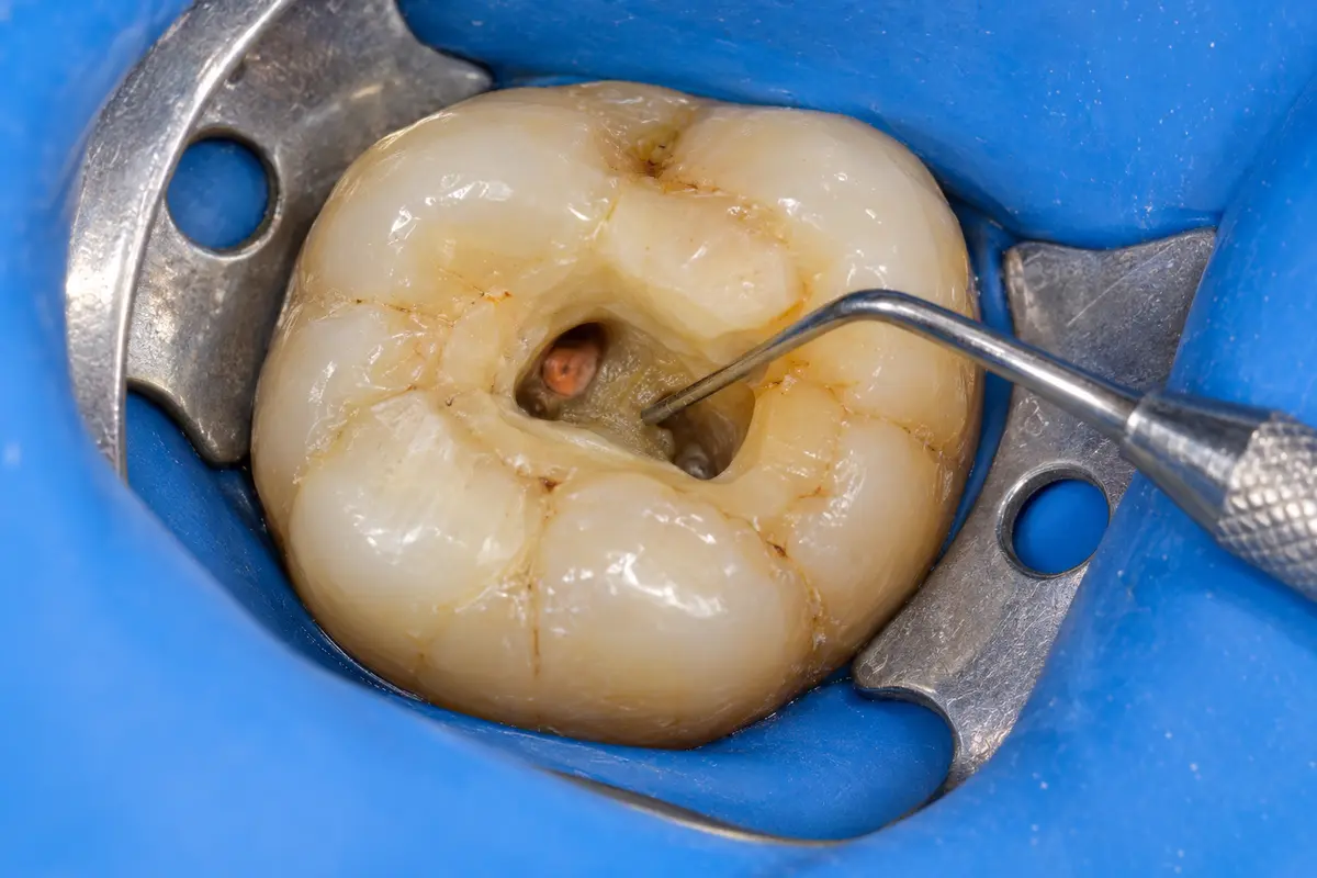 Clinical illustration: find the cause and plan access during re-root canal treatment