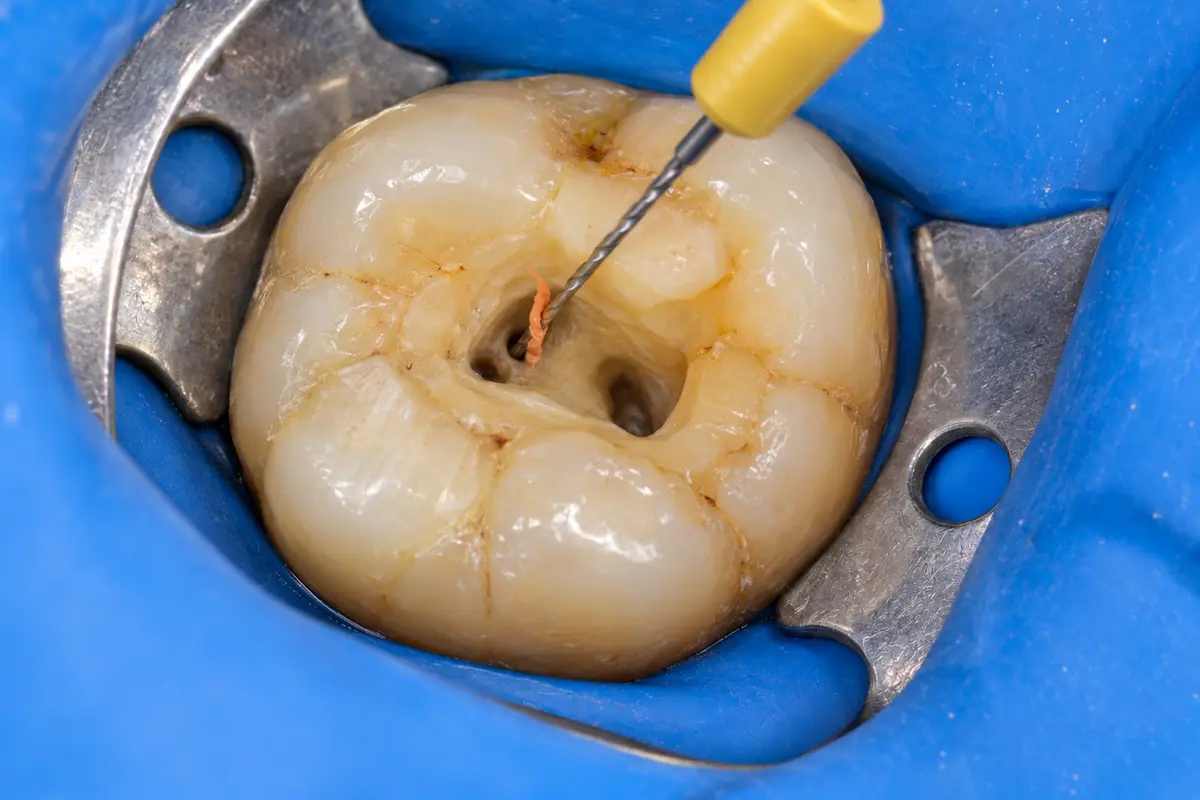 Clinical illustration: remove old filling and re-clean during re-root canal treatment