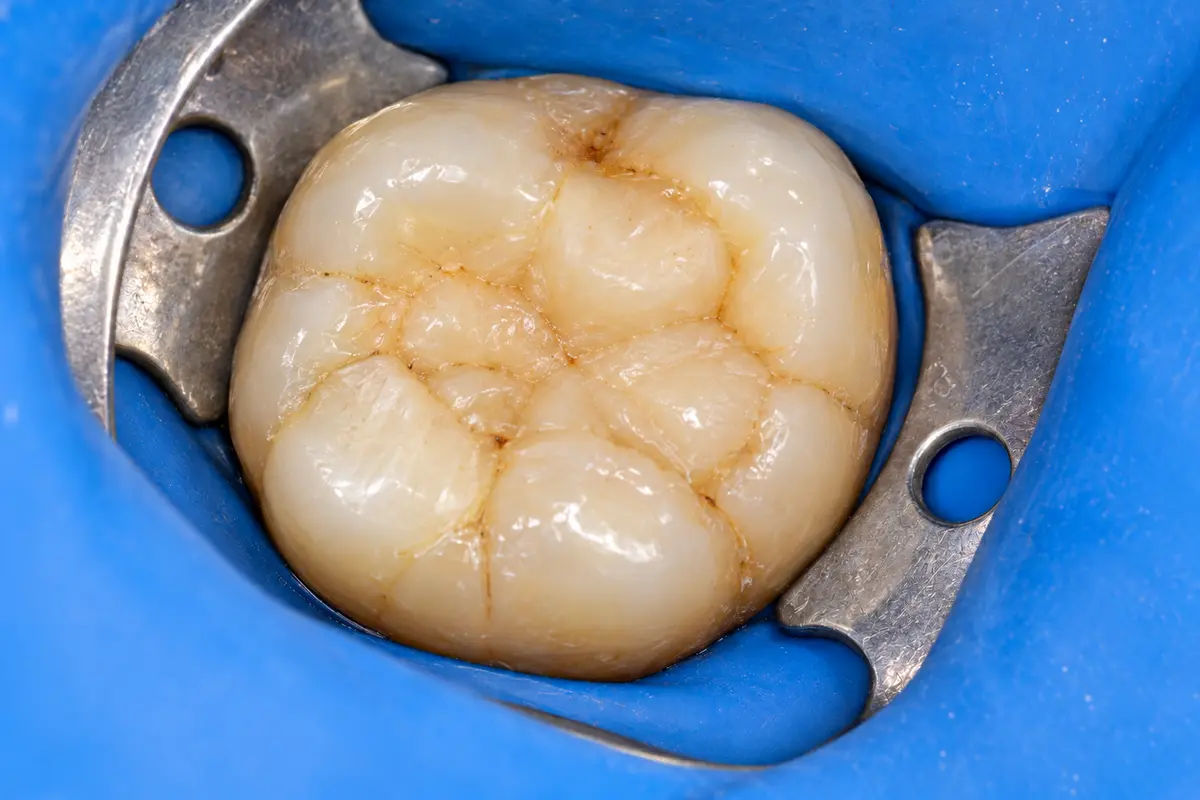 Clinical illustration: refill, restore and review during re-root canal treatment
