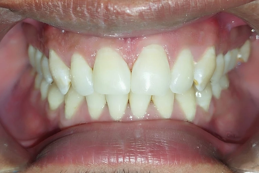 After treatment at DentCare — case 1: Front tooth repair
