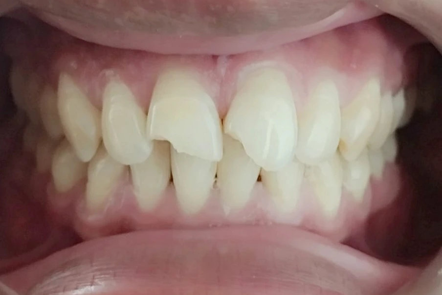 Before treatment at DentCare — case 1: Front tooth repair
