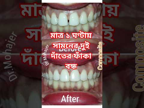 সামনের দাঁতের ফাঁক বন্ধ করার চিকিৎসা video thumbnail