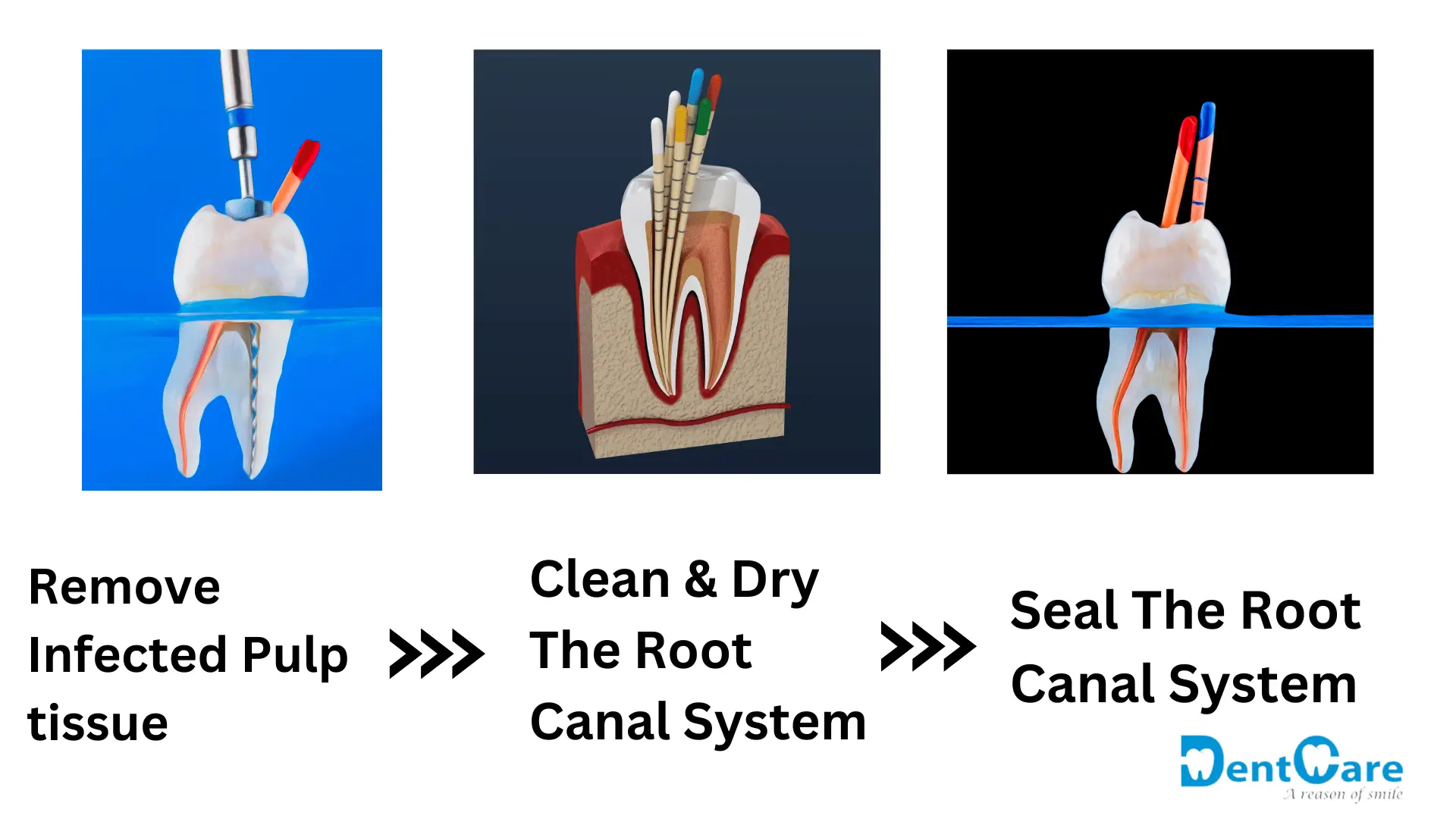 How root canal treatment works - step-by-step process